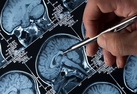Investigación en cirugía cerebral, Servicio de Vascular y Tumores Neurocirugía Almenara