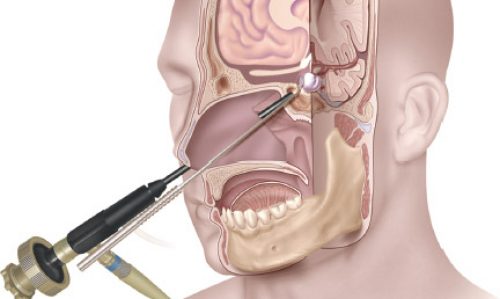 Novedosa Técnica de Cirugía Endoscópica Endonasal para Tumores de Hipófisis en Neurocirugía Almenara Perú