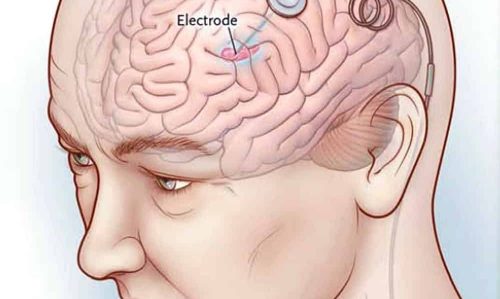 Cirugía cerebral de Parkinson en Neurocirugía Almenara Perú